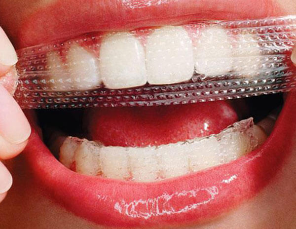 بررسی اثر نوار سفید کننده دندان بر مینا