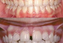 قبل و بعد ارتودنسی - نمونه ارتودنسی ثابت شماره 2