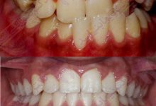 قبل و بعد ارتودنسی - نمونه ارتودنسی ثابت شماره 4