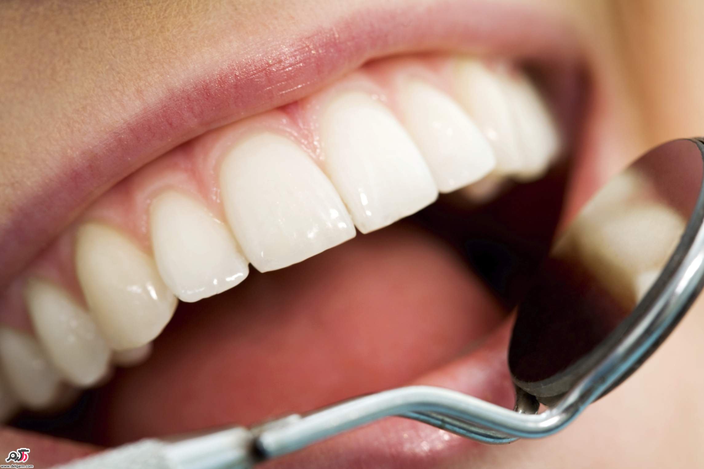 لامینت دندان یا ارتودنسی