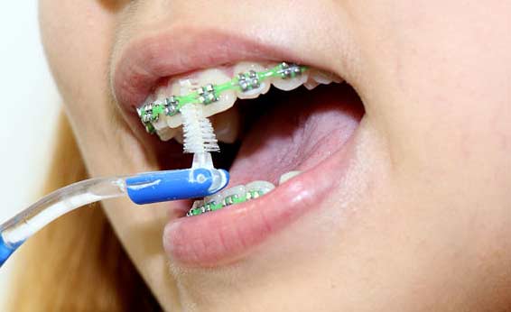 رعایت نکات بهداشتی در دندان ارتودنسی شده