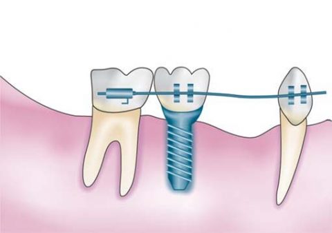 ایمپلنت دندانی و ارتودنسی