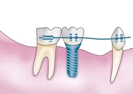 ایمپلنت دندانی و ارتودنسی