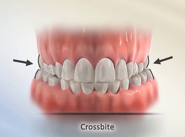 درمان ارتودنسی برای رفع کراس بایت