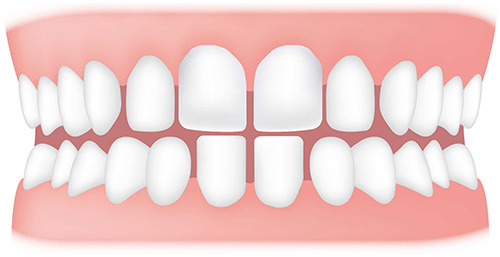 دلیل فضای خالی بین دندان ها