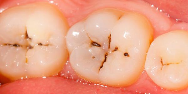 پوسیدگی مینای دندان چگونه شروع می شود و چگونه آن را متوقف کرد