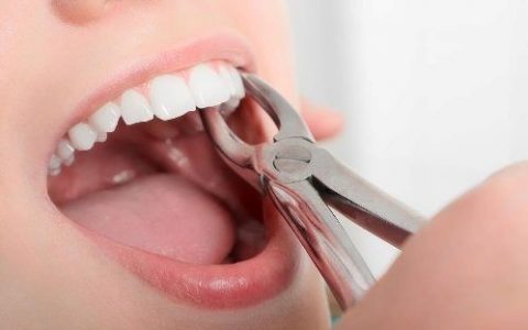 کشیدن دندان برای ارتودنسی