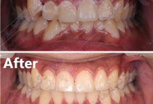 نمونه ارتودنسی ثابت شماره 35
