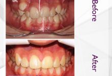 نمونه ارتودنسی ثابت شماره 45