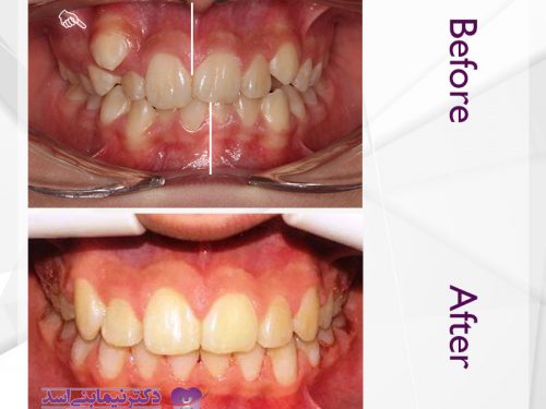 نمونه ارتودنسی ثابت شماره 45
