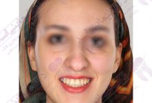 نمونه ارتودنسی ثابت شماره 44