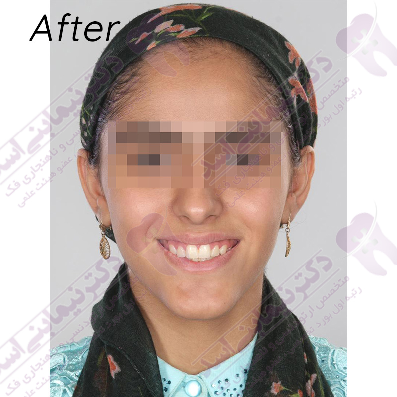 نمونه ارتودنسی ثابت شماره 43