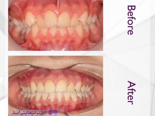 نمونه ارتودنسی ثابت شماره 47