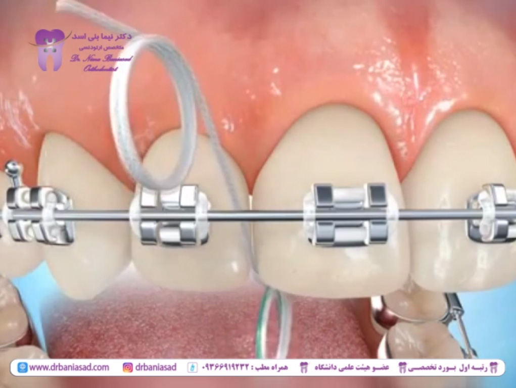 روش استفاده از نخ دندان در درمان ارتودنسی