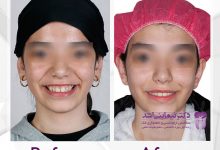 نمونه ارتودنسی ثابت شماره 50