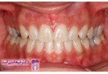 نمونه ارتودنسی ثابت شماره 48