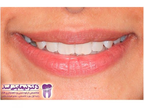 نمونه ارتودنسی ثابت شماره 48