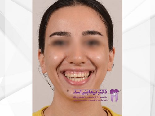 نمونه ارتودنسی ثابت شماره 53