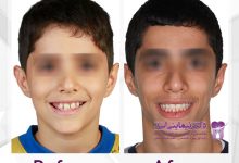 نمونه ارتودنسی ثابت شماره 49