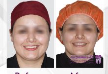 نمونه ارتودنسی ثابت شماره 57