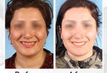 نمونه ارتودنسی ثابت شماره 54