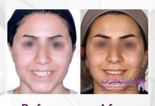 نمونه ارتودنسی ثابت شماره 60