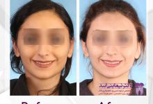 نمونه ارتودنسی ثابت شماره 63