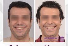 نمونه ارتودنسی ثابت شماره 65