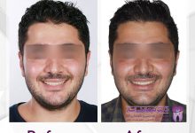 نمونه ارتودنسی ثابت شماره 68