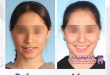 نمونه ارتودنسی ثابت شماره 69