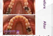 نمونه ارتودنسی ثابت شماره 75
