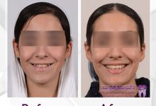 نمونه ارتودنسی ثابت شماره 74