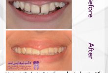 نمونه ارتودنسی ثابت شماره 76