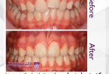 نمونه ارتودنسی ثابت شماره 79