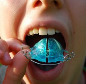 استفاده از فضا نگهدارنده های ارتودنسی