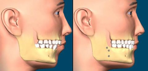 انواع درمان های ارتودنسی جهت اصلاح فک و صورت