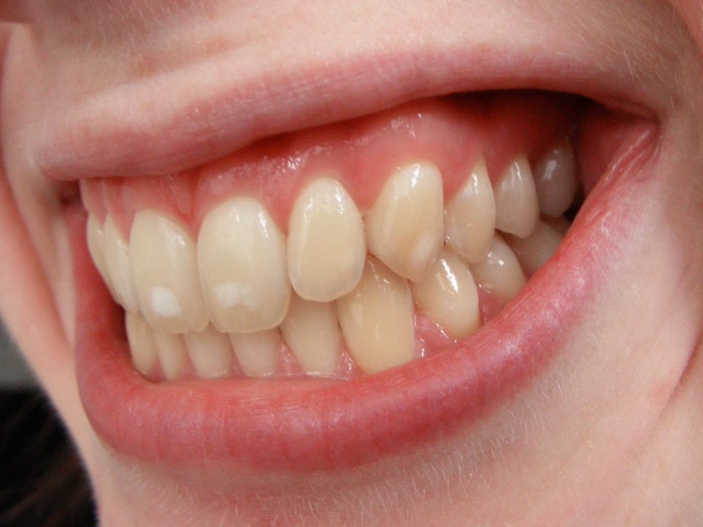 لکه های سفید ( White Spot ) در حین درمان ارتودنسی