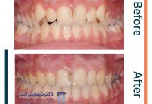 نمونه ارتودنسی ثابت شماره 80