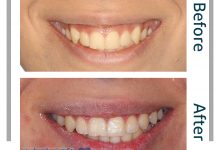 نمونه ارتودنسی ثابت شماره 82