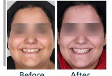 نمونه ارتودنسی ثابت شماره 83