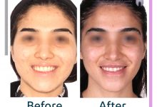 نمونه ارتودنسی ثابت شماره 89