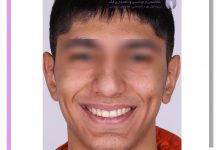 نمونه ارتودنسی ثابت شماره 96