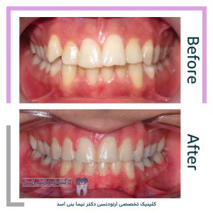 نمونه ارتودنسی ثابت شماره 90