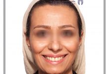 نمونه ارتودنسی ثابت شماره 91