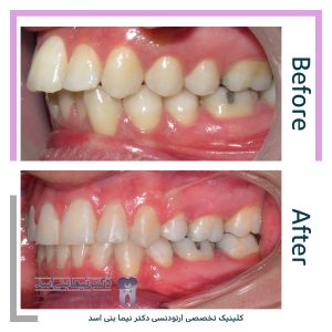 نمونه ارتودنسی ثابت شماره 90