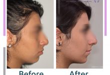 نمونه ارتودنسی ثابت شماره 90