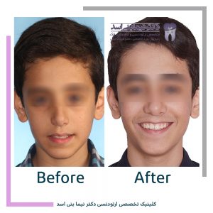 نمونه ارتودنسی ثابت شماره 94