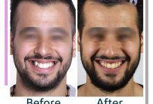 نمونه ارتودنسی ثابت شماره 98
