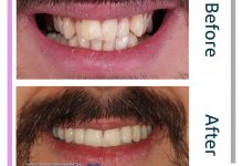 نمونه ارتودنسی ثابت شماره 92