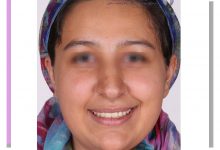 نمونه ارتودنسی ثابت شماره 97